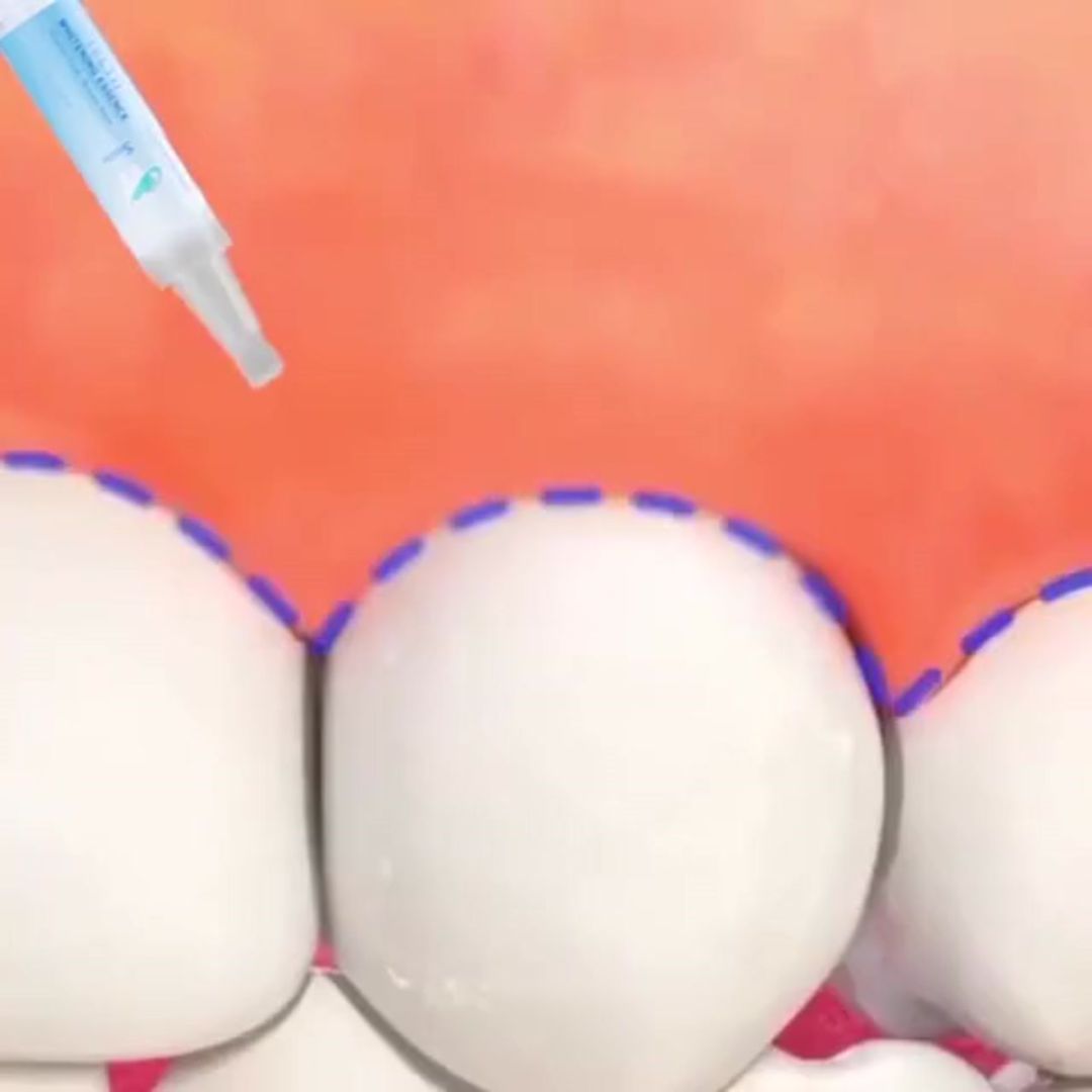 BLANQUEADOR DENTAL ULTRA 4K